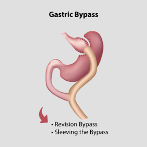 Gastric Bypass Surgery | International Patient Facilitators