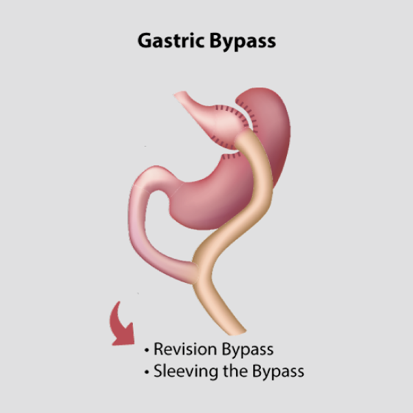 GASTRIC BYPASS SURGERY